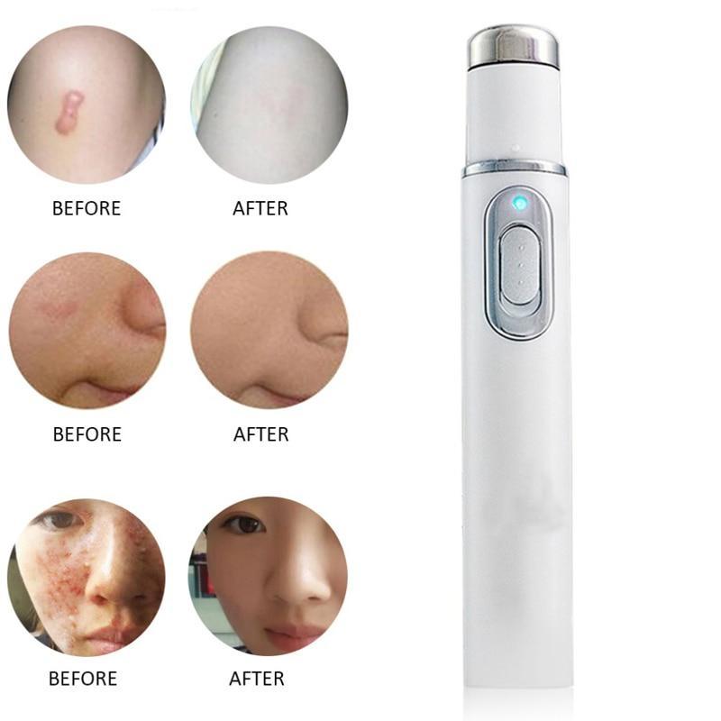 Blue Light Laser Pen for Spots, Scars &amp; Tattoos