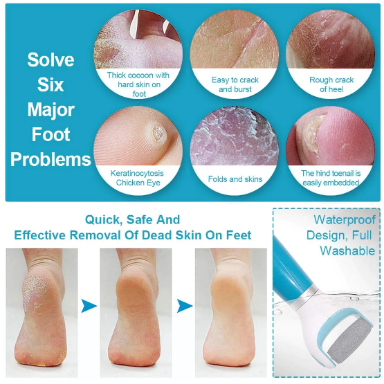 calluses-on-feet