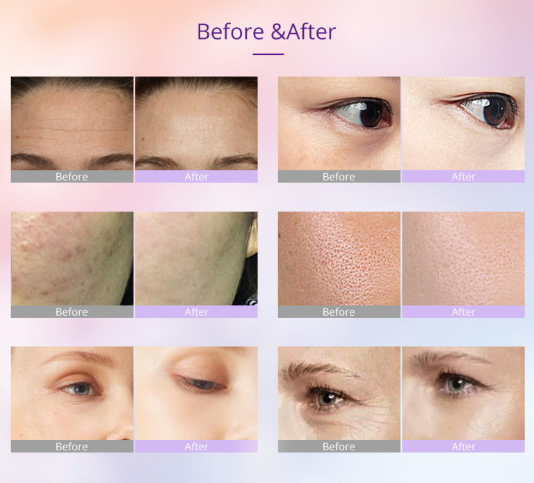 microcurrent-facial