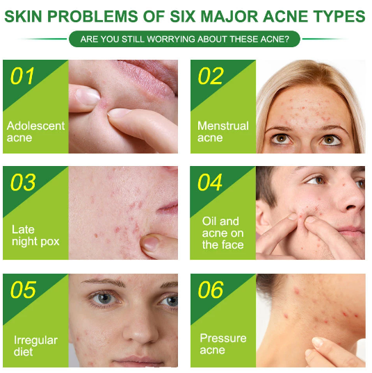 pimple-patches